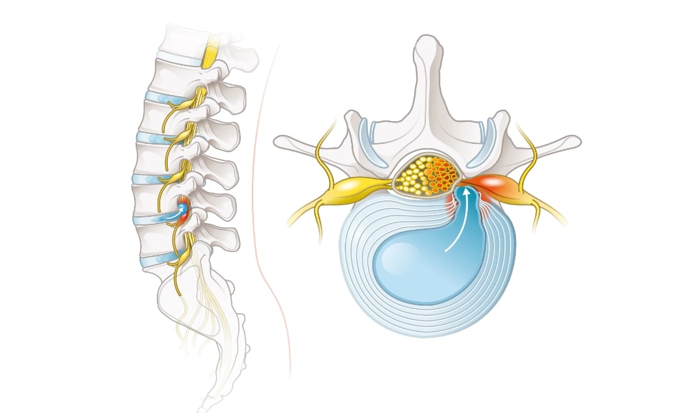 椎間板の髄核の逸脱の画像